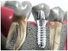 Gum Recession - Florida Institute for Periodontics and Dental Implants