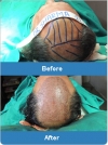Best-Hair-Transplant-Surgeons-and-Clinics-in-India-@-Best-Cost-